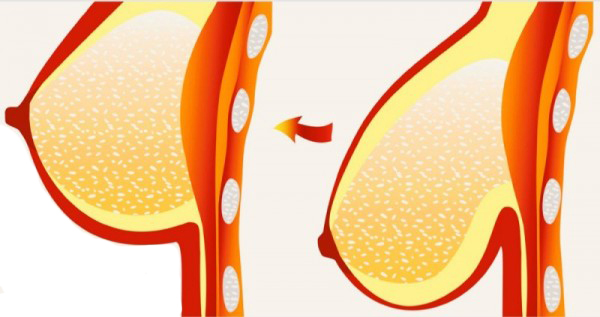 رفع افتادگی سینه با لیفت سینه